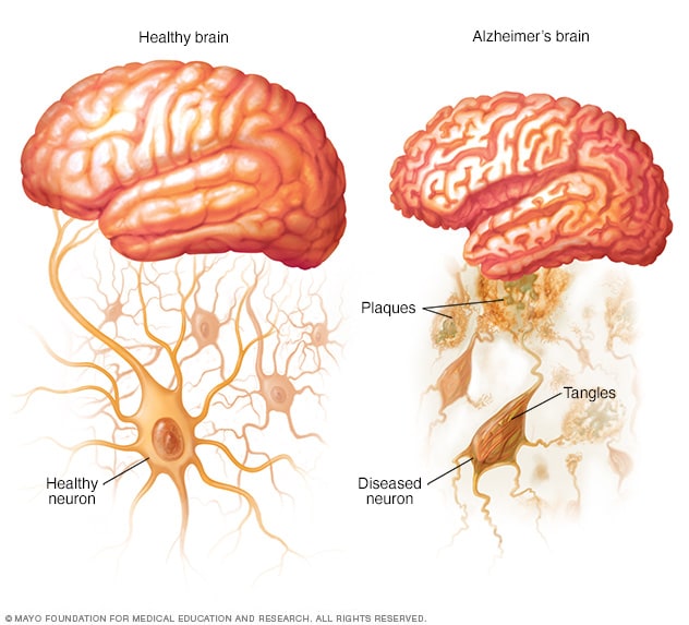 Understanding Alzheimer’s Disease and Dementia: A Comprehensive Overview