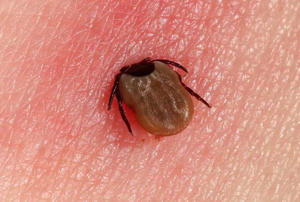 Understanding Lyme Disease: A Recent Case in Ernakulam, Kerala             